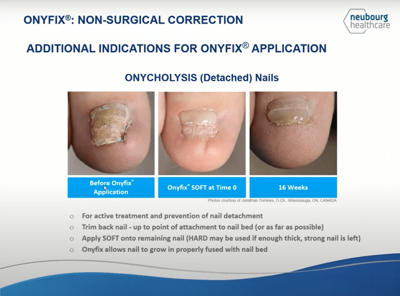 toenail treatment