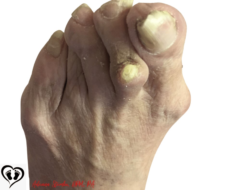 Foot Calluses, Why They Develop & How to Treat Them
