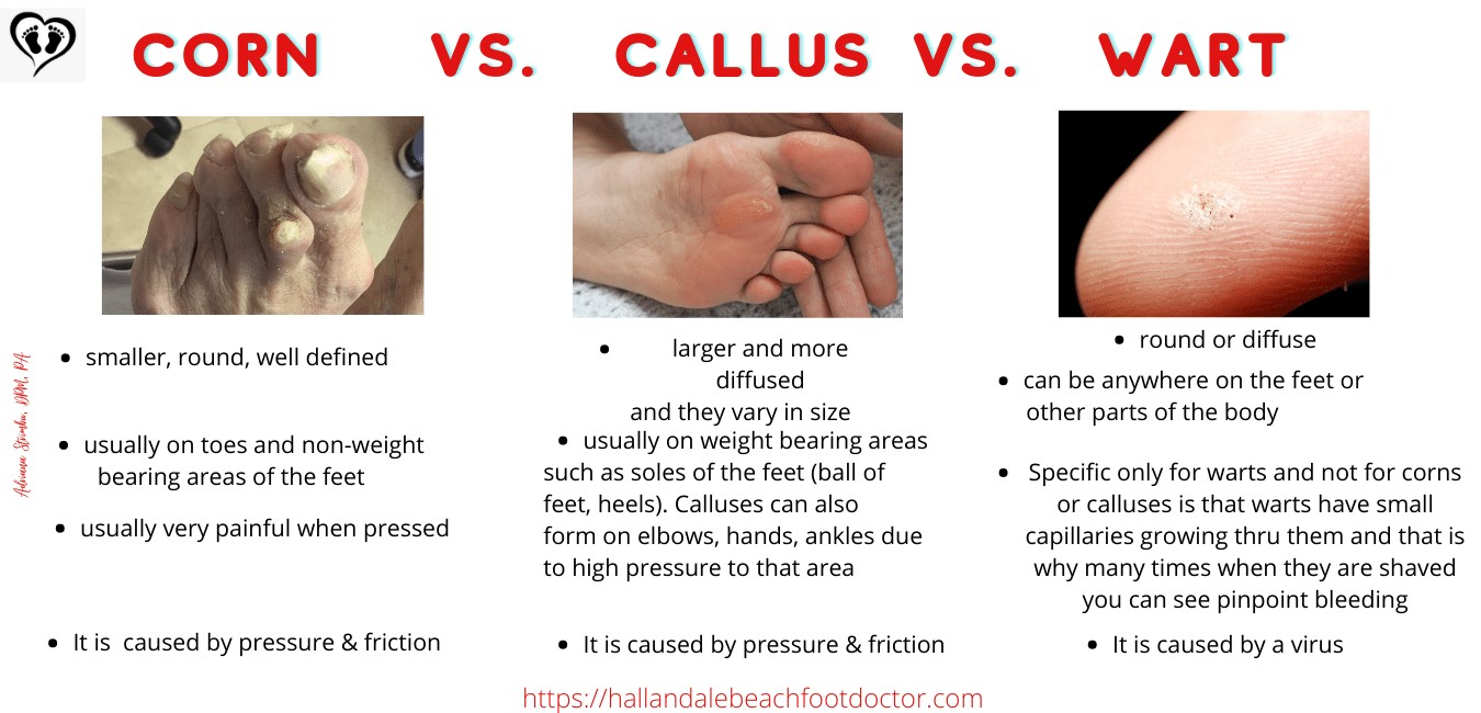 Blog - Causes,Prevention & Treatment of Corn Calluses