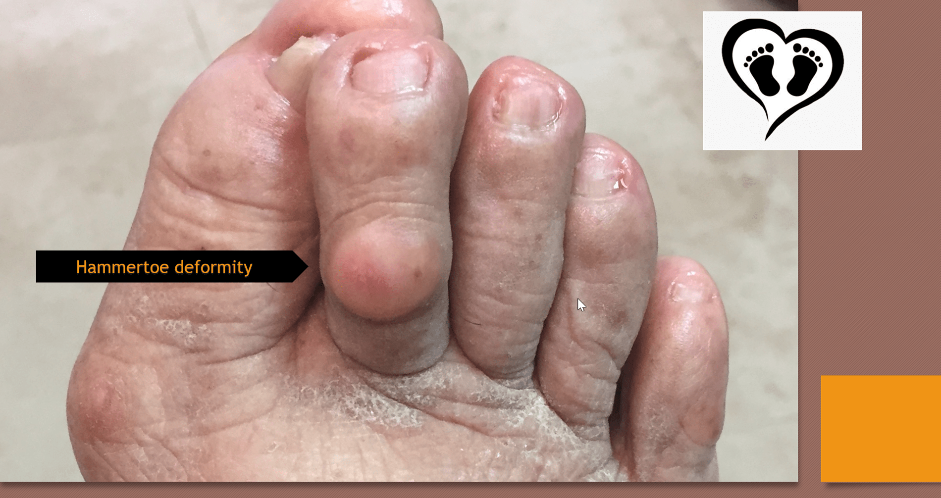 What You Can Do About Hammertoes