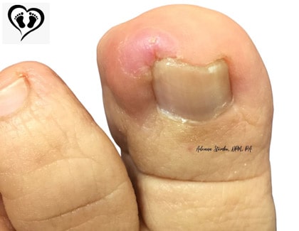 Painful thickened toenails — Mackay Ingrown Toenail Clinic