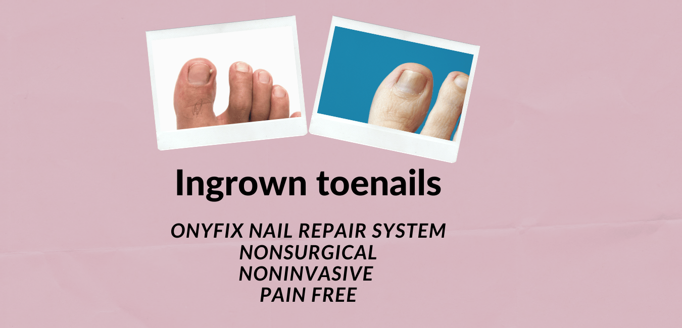 Ingrown Toe Nails | Causes and treatment options | MyFootShop.com