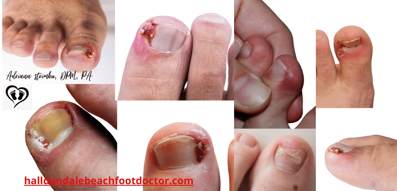 Ingrown Toenails Treatment Podiatrist Foot Doctor Hallandale Beach 